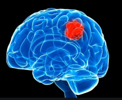 Beyin tümörlerinde embolizasyon